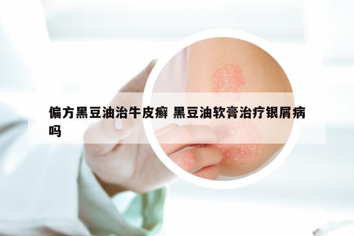 偏方黑豆油治牛皮癣 黑豆油软膏治疗银屑病吗