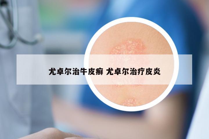 尤卓尔治牛皮癣 尤卓尔治疗皮炎