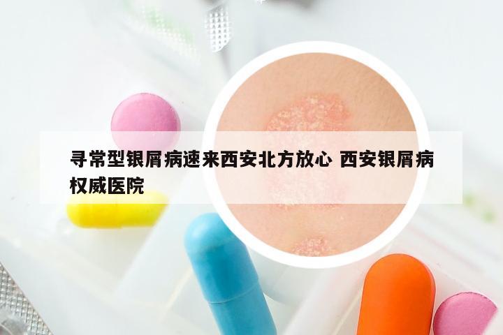 寻常型银屑病速来西安北方放心 西安银屑病权威医院