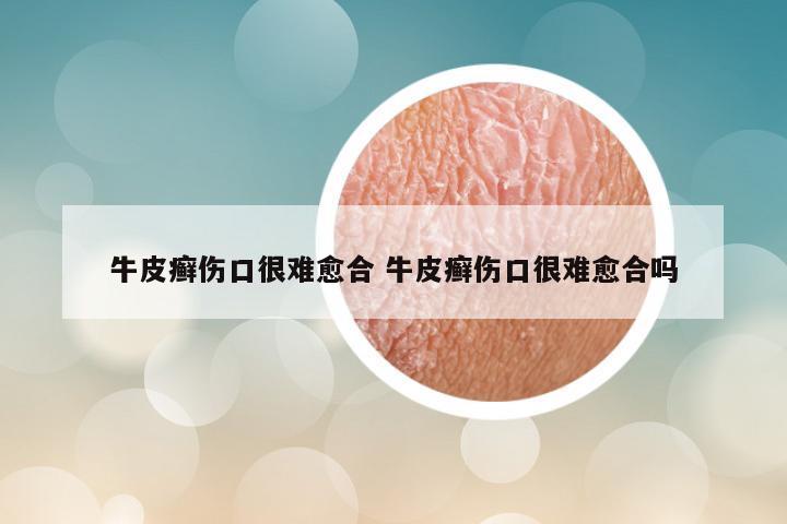 牛皮癣伤口很难愈合 牛皮癣伤口很难愈合吗