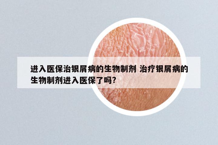进入医保治银屑病的生物制剂 治疗银屑病的生物制剂进入医保了吗?