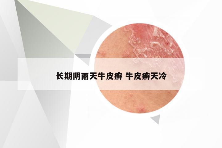 长期阴雨天牛皮癣 牛皮癣天冷