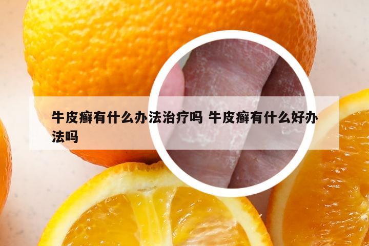 牛皮癣有什么办法治疗吗 牛皮癣有什么好办法吗