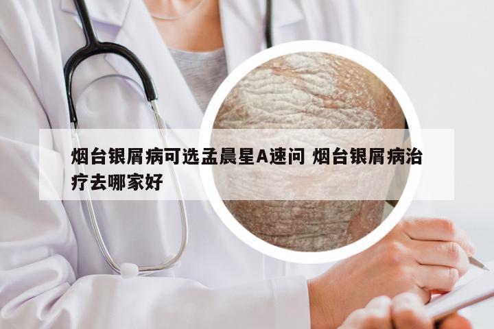 烟台银屑病可选孟晨星A速问 烟台银屑病治疗去哪家好