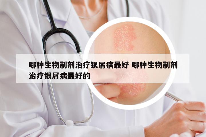 哪种生物制剂治疗银屑病最好 哪种生物制剂治疗银屑病最好的