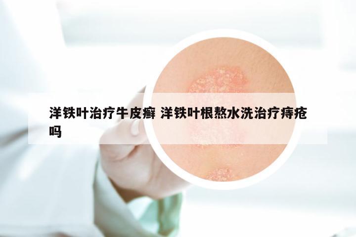 洋铁叶治疗牛皮癣 洋铁叶根熬水洗治疗痔疮吗