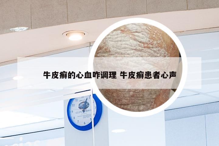 牛皮癣的心血咋调理 牛皮癣患者心声
