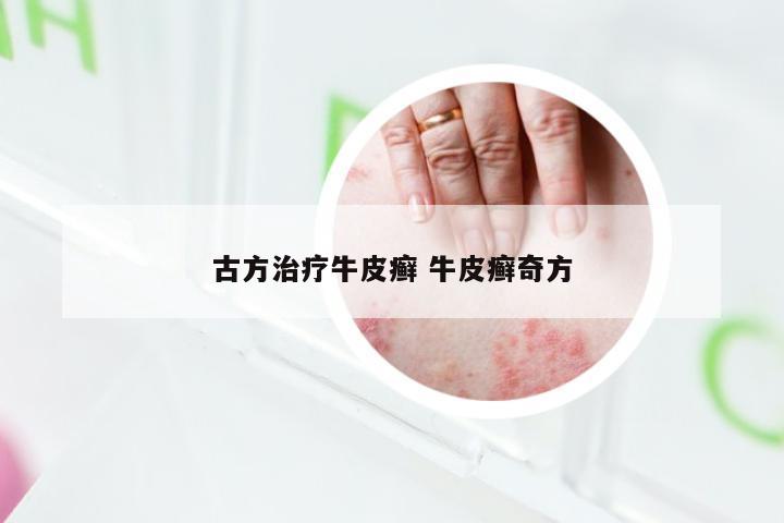 古方治疗牛皮癣 牛皮癣奇方