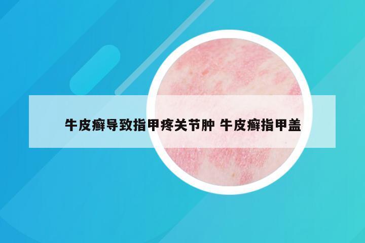 牛皮癣导致指甲疼关节肿 牛皮癣指甲盖