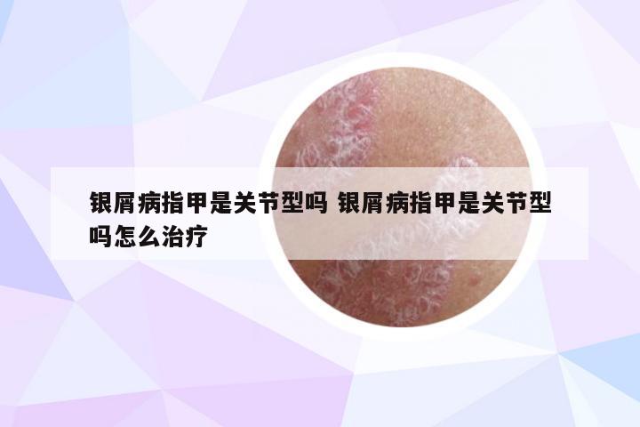 银屑病指甲是关节型吗 银屑病指甲是关节型吗怎么治疗