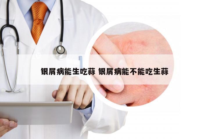 银屑病能生吃蒜 银屑病能不能吃生蒜
