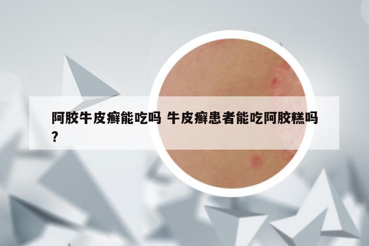 阿胶牛皮癣能吃吗 牛皮癣患者能吃阿胶糕吗?