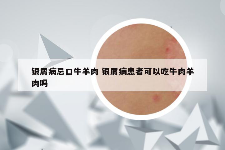 银屑病忌口牛羊肉 银屑病患者可以吃牛肉羊肉吗