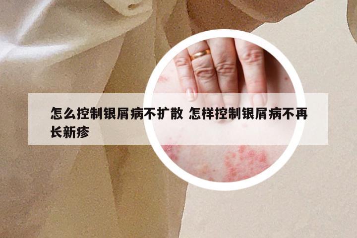 怎么控制银屑病不扩散 怎样控制银屑病不再长新疹