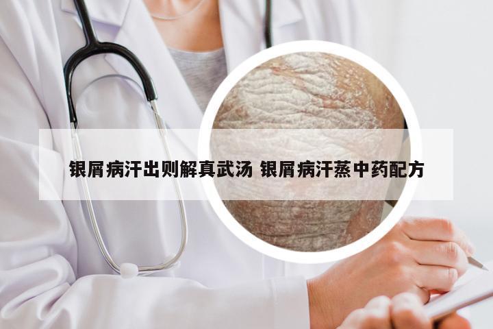 银屑病汗出则解真武汤 银屑病汗蒸中药配方