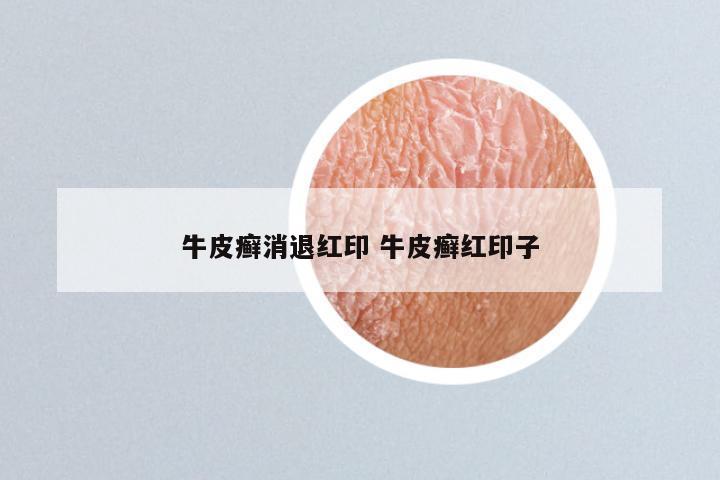 牛皮癣消退红印 牛皮癣红印子