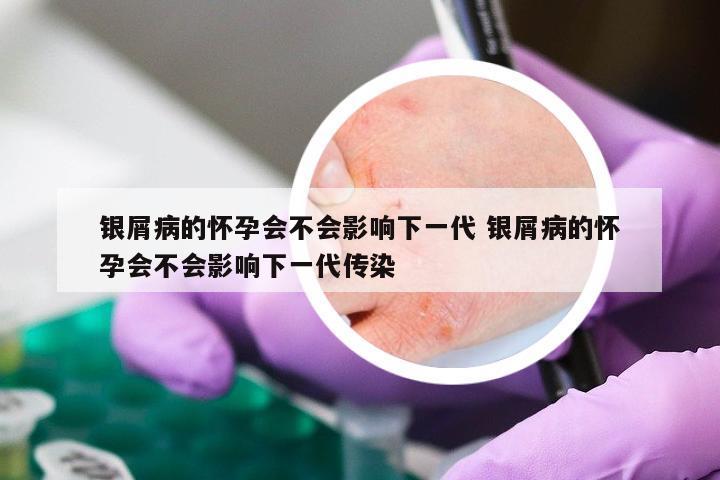 银屑病的怀孕会不会影响下一代 银屑病的怀孕会不会影响下一代传染