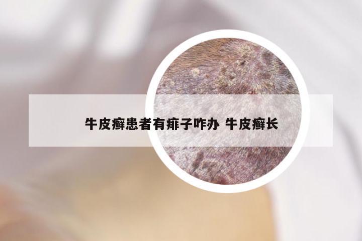 牛皮癣患者有痱子咋办 牛皮癣长