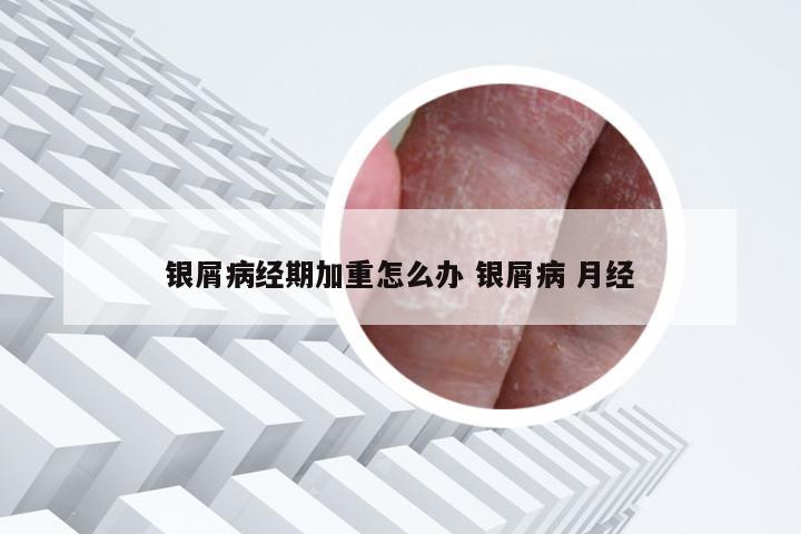 银屑病经期加重怎么办 银屑病 月经