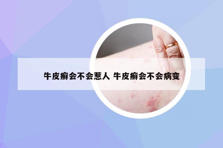 牛皮癣会不会惹人 牛皮癣会不会病变