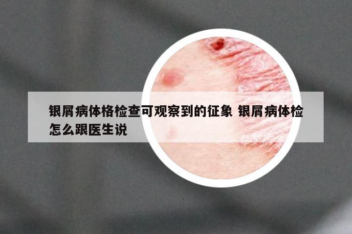 银屑病体格检查可观察到的征象 银屑病体检怎么跟医生说