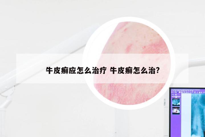 牛皮癣应怎么治疗 牛皮癣怎么治?