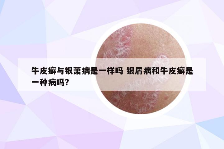 牛皮癣与银萧病是一样吗 银屑病和牛皮癣是一种病吗?