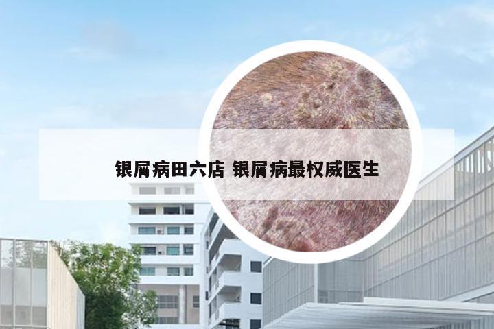 银屑病田六店 银屑病最权威医生
