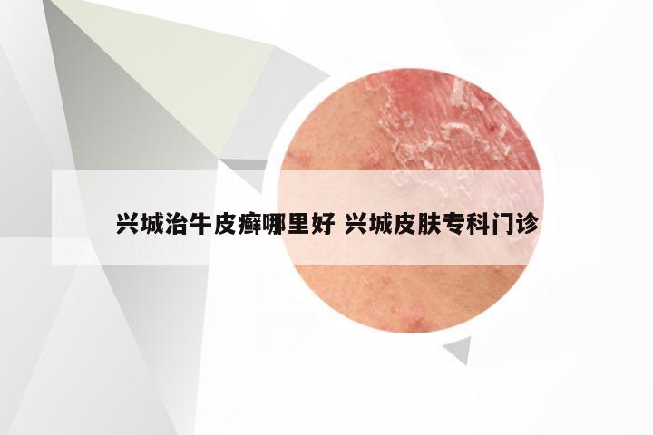兴城治牛皮癣哪里好 兴城皮肤专科门诊