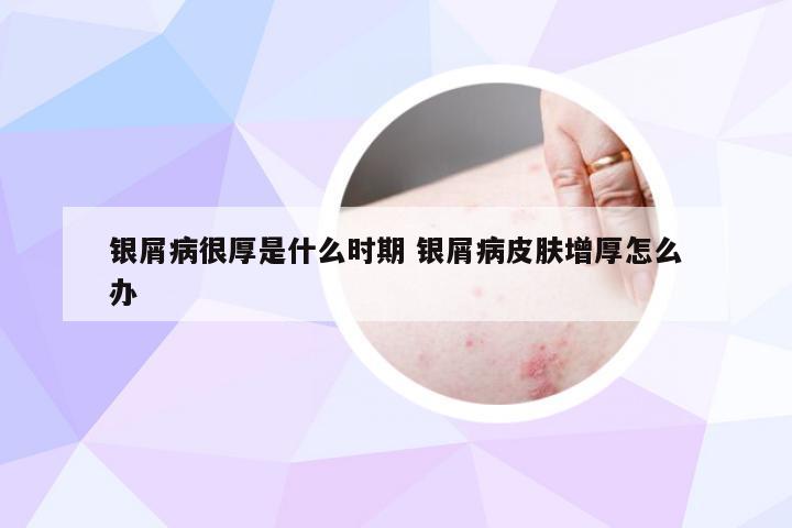 银屑病很厚是什么时期 银屑病皮肤增厚怎么办