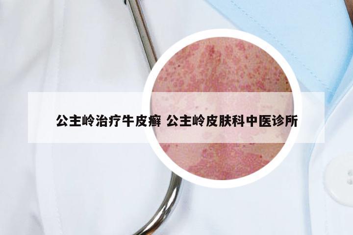 公主岭治疗牛皮癣 公主岭皮肤科中医诊所