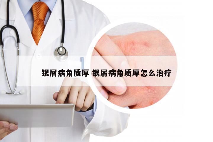 银屑病角质厚 银屑病角质厚怎么治疗