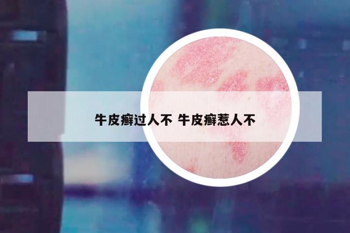 牛皮癣过人不 牛皮癣惹人不