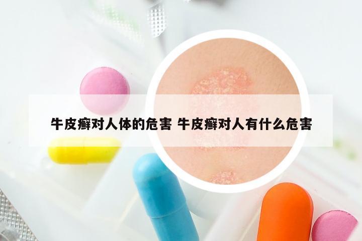 牛皮癣对人体的危害 牛皮癣对人有什么危害