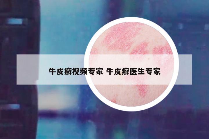 牛皮癣视频专家 牛皮癣医生专家