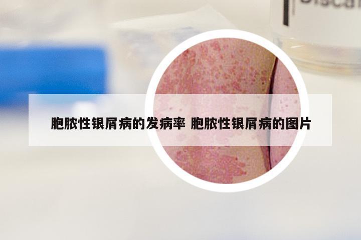 胞脓性银屑病的发病率 胞脓性银屑病的图片
