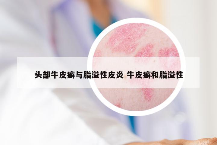 头部牛皮癣与脂溢性皮炎 牛皮癣和脂溢性
