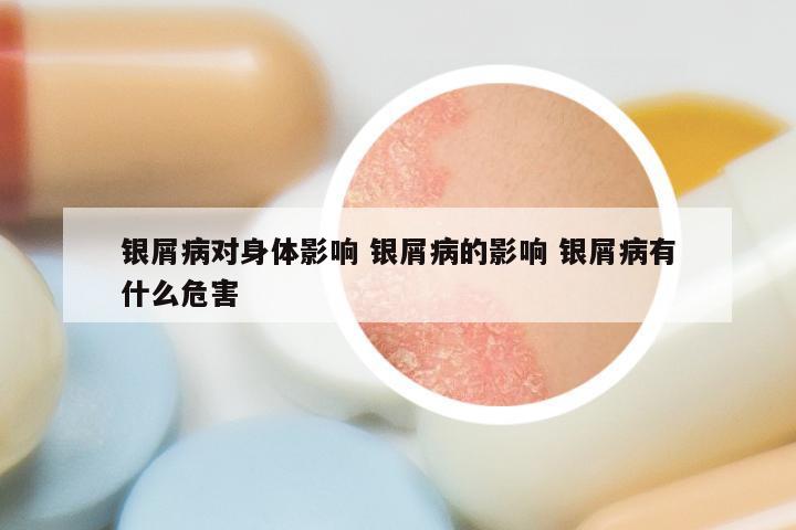 银屑病对身体影响 银屑病的影响 银屑病有什么危害