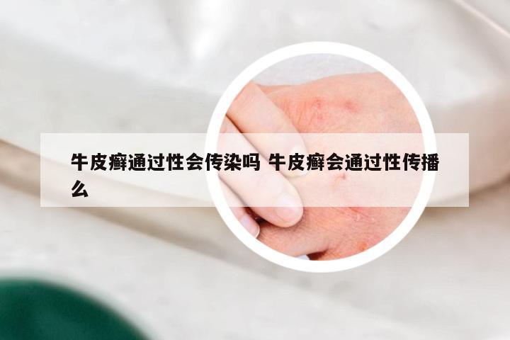 牛皮癣通过性会传染吗 牛皮癣会通过性传播么