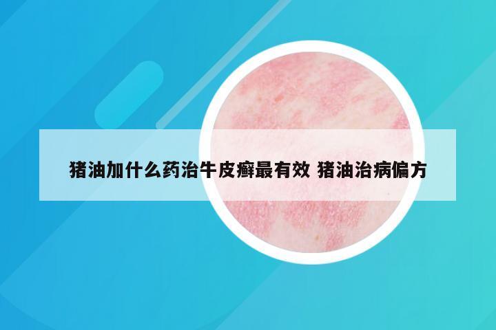 猪油加什么药治牛皮癣最有效 猪油治病偏方