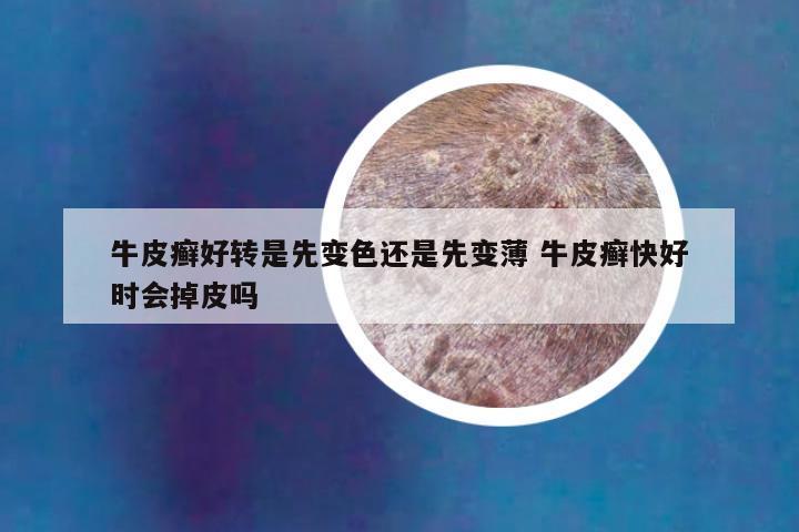 牛皮癣好转是先变色还是先变薄 牛皮癣快好时会掉皮吗