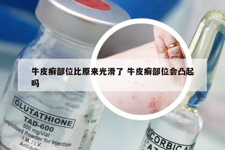 牛皮癣部位比原来光滑了 牛皮癣部位会凸起吗