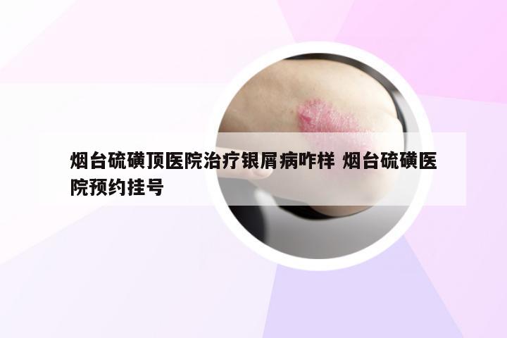 烟台硫磺顶医院治疗银屑病咋样 烟台硫磺医院预约挂号