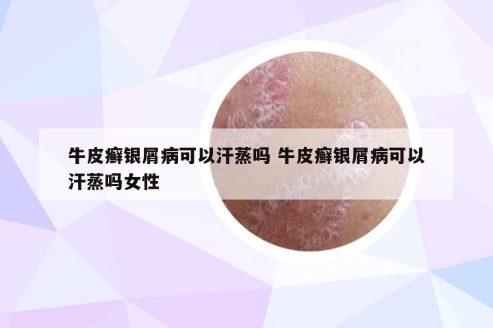 牛皮癣银屑病可以汗蒸吗 牛皮癣银屑病可以汗蒸吗女性