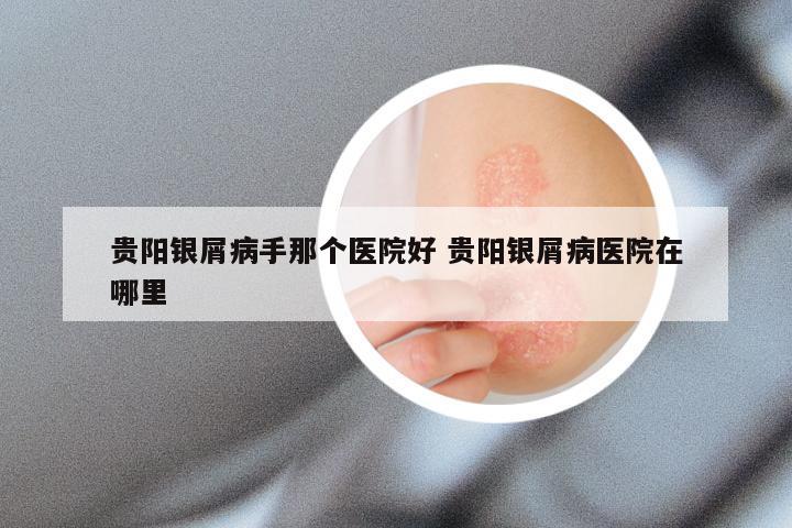贵阳银屑病手那个医院好 贵阳银屑病医院在哪里