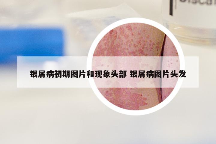 银屑病初期图片和现象头部 银屑病图片头发