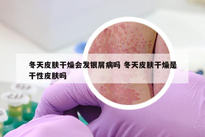 冬天皮肤干燥会发银屑病吗 冬天皮肤干燥是干性皮肤吗