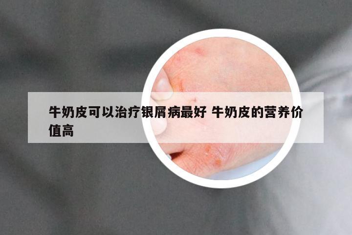 牛奶皮可以治疗银屑病最好 牛奶皮的营养价值高