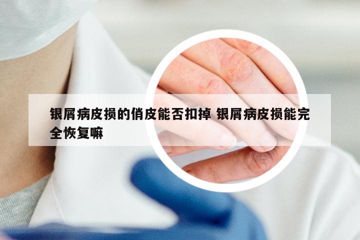 银屑病皮损的俏皮能否扣掉 银屑病皮损能完全恢复嘛