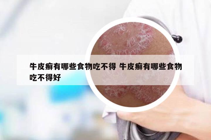 牛皮癣有哪些食物吃不得 牛皮癣有哪些食物吃不得好